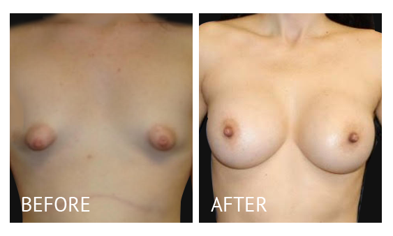 Best cost breast augmentation before and after in Manila Philippines #14