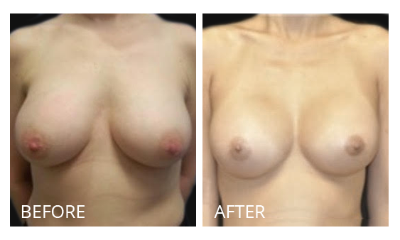 The Breast Surgery Center Philippines Best cost breast implant removal before and after in Manila Philippines #23