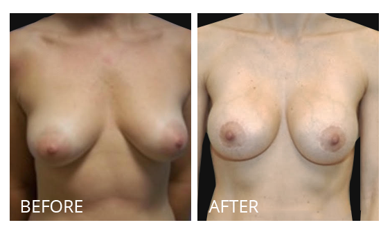 The Breast Surgery Center Philippines Best cost breast implant removal before and after in Manila Philippines #26