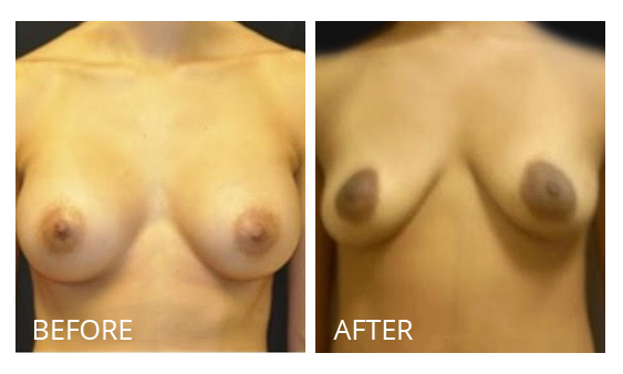The Breast Surgery Center Philippines Best cost breast implant removal before and after in Manila Philippines #27