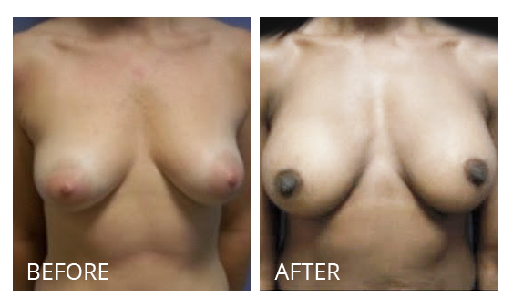 The Breast Surgery Center Philippines Best cost breast implant removal before and after in Manila Philippines #28