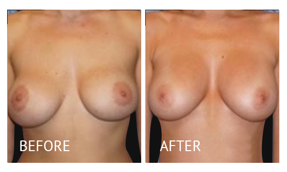 Best cost breast implant removal before and after in Manila Philippines #4