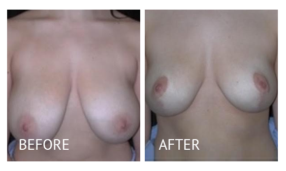 Best cost breast reduction before and after in Manila Philippines #12
