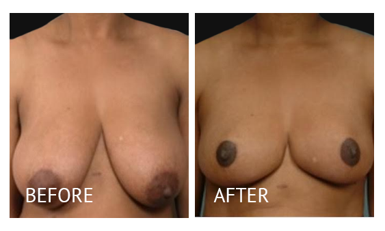 Best cost breast reduction before and after in Manila Philippines #15
