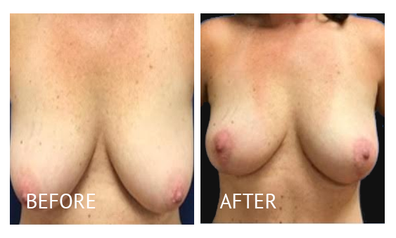 Best cost breast reduction before and after in Manila Philippines #17