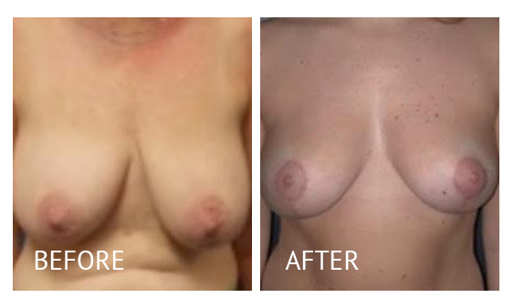 Best cost breast reduction before and after in Manila Philippines #18