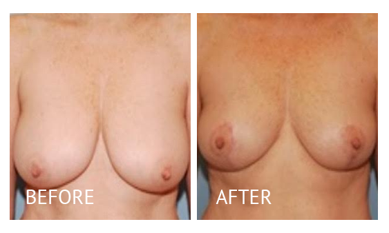 Best cost breast reduction before and after in Manila Philippines #20