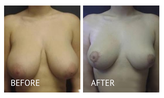 The Breast Surgery Center Philippines Best cost breast lift before and after in Manila Philippines #30